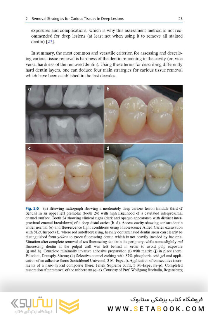 Management of Deep Carious Lesions 2018