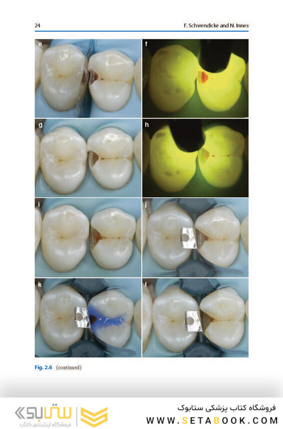 Management of Deep Carious Lesions 2018
