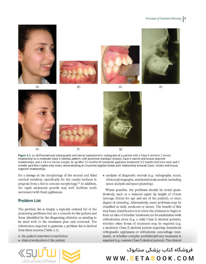 Preadjusted Edgewise Fixed Orthodontic Appliances: Principles and Practice 1st Edicion