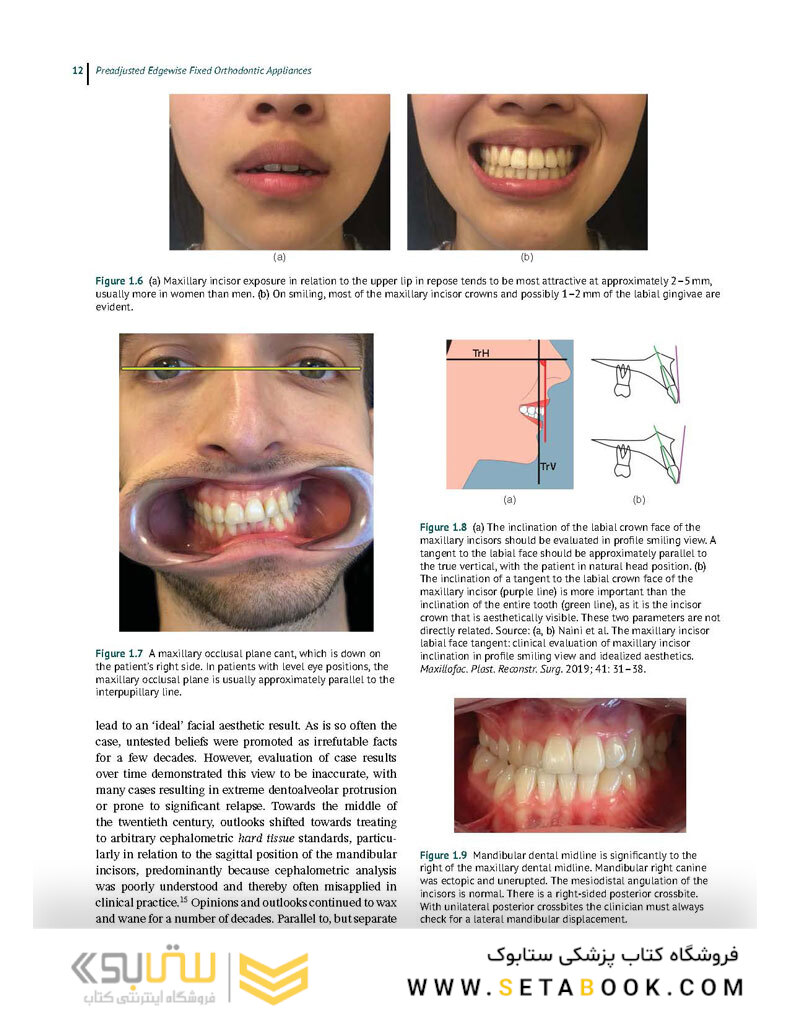 Preadjusted Edgewise Fixed Orthodontic Appliances: Principles and Practice 1st Edicion