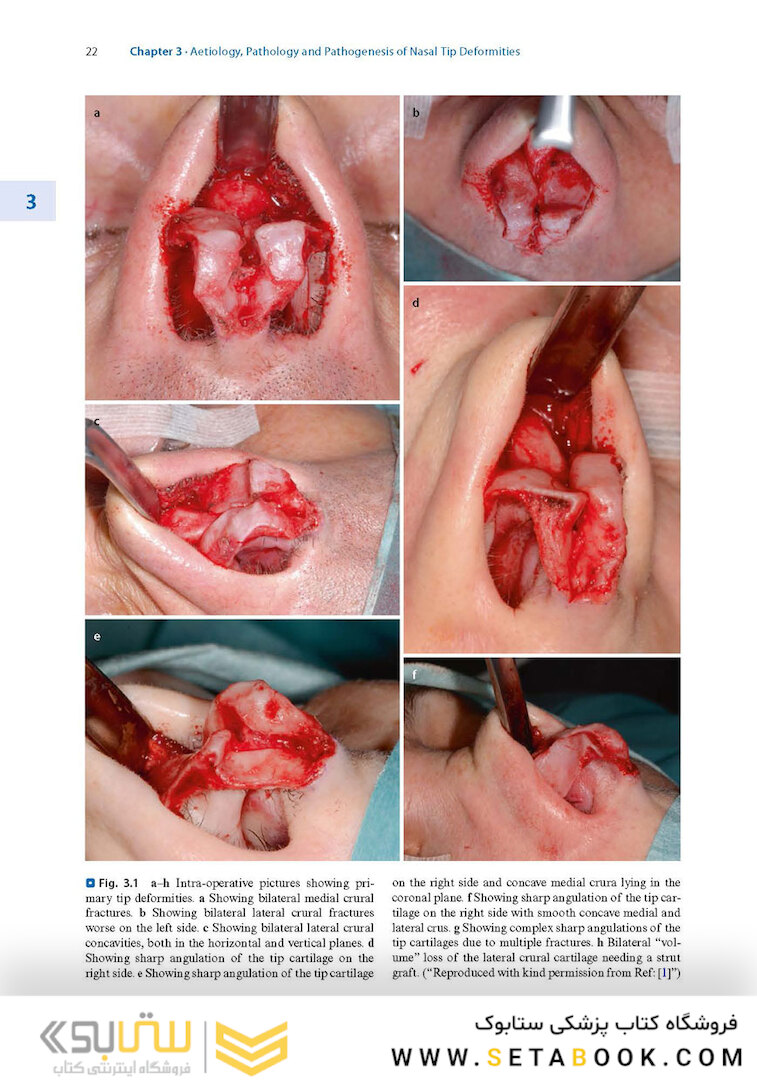 Textbook of Nasal Tip Rhinoplasty : Open Surgical Techniques