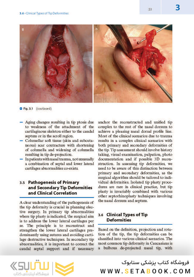Textbook of Nasal Tip Rhinoplasty : Open Surgical Techniques