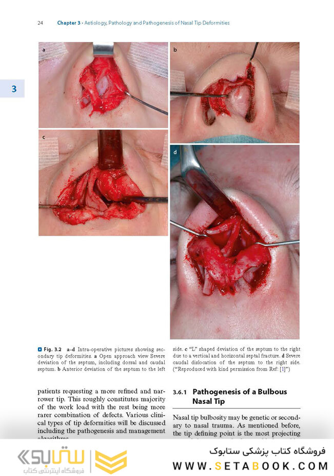 Textbook of Nasal Tip Rhinoplasty : Open Surgical Techniques