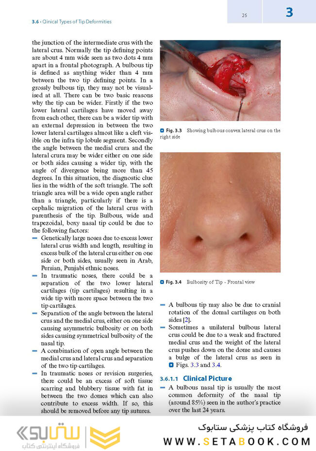 Textbook of Nasal Tip Rhinoplasty : Open Surgical Techniques