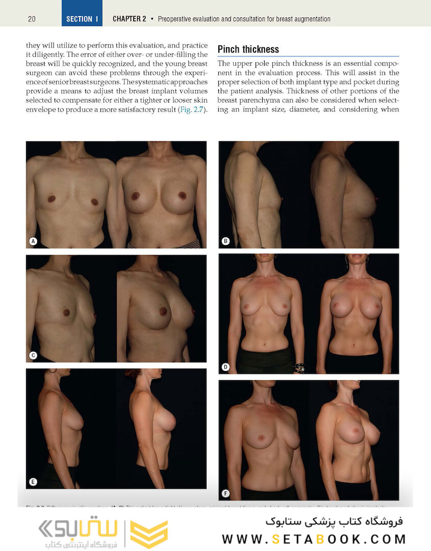 Plastic Surgery Volume 5: Breast 4th Edicion 2018