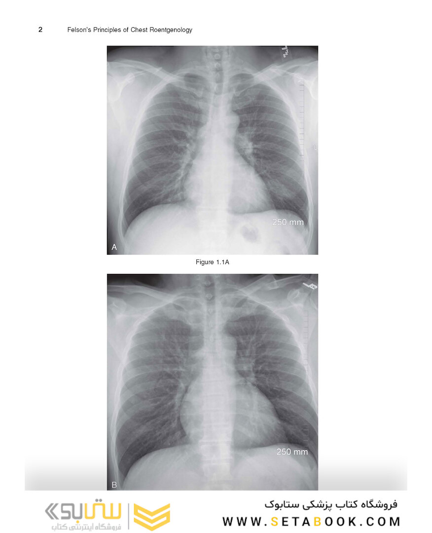 Felson’s PRINCIPLES OF CHEST ROENTGENOLOGY