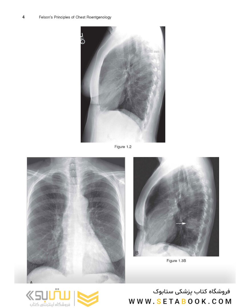 Felson’s PRINCIPLES OF CHEST ROENTGENOLOGY