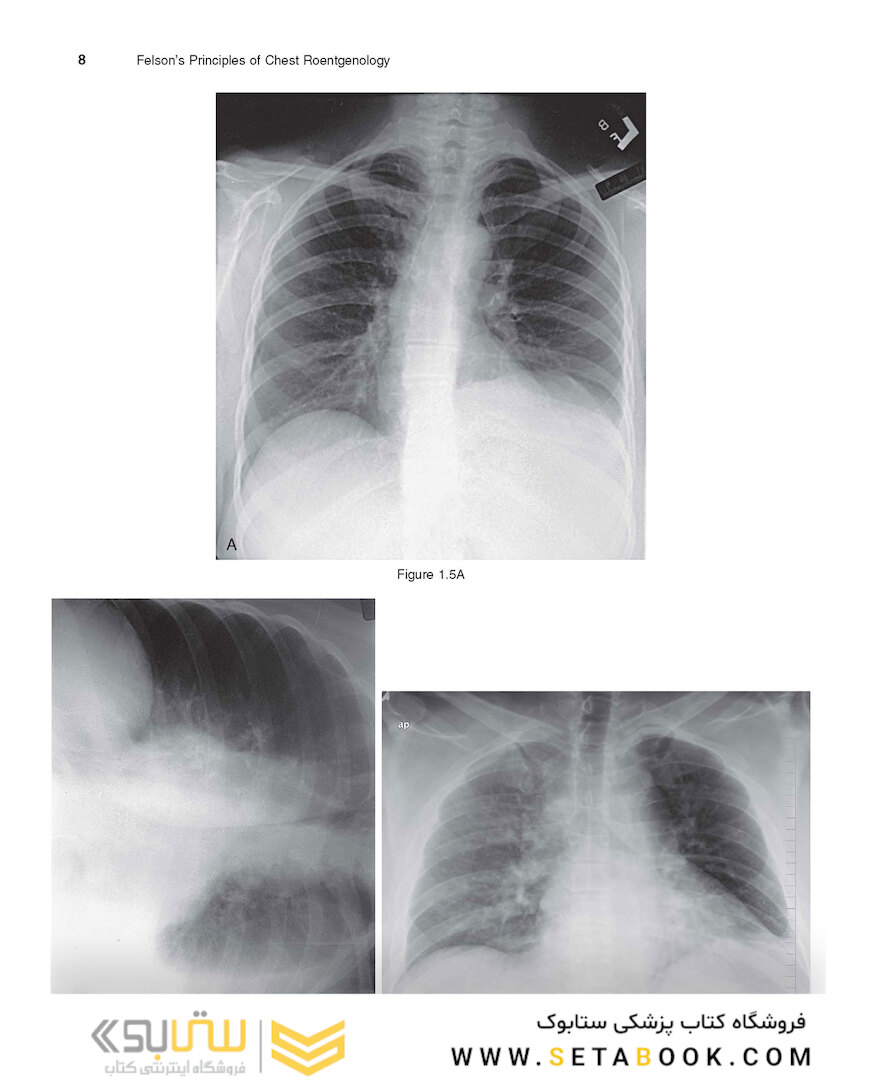 Felson’s PRINCIPLES OF CHEST ROENTGENOLOGY