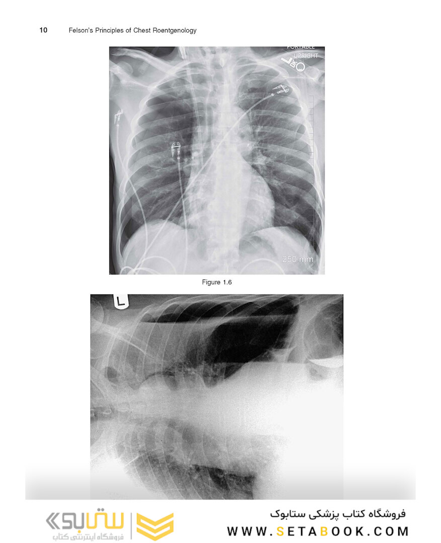 Felson’s PRINCIPLES OF CHEST ROENTGENOLOGY