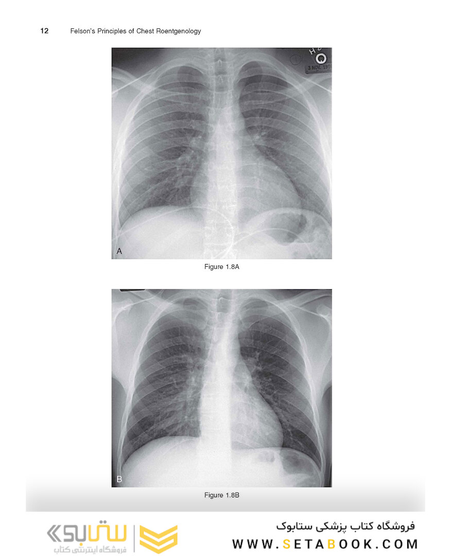 Felson’s PRINCIPLES OF CHEST ROENTGENOLOGY