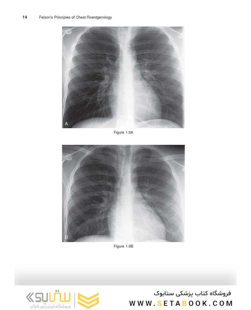 Felson’s PRINCIPLES OF CHEST ROENTGENOLOGY