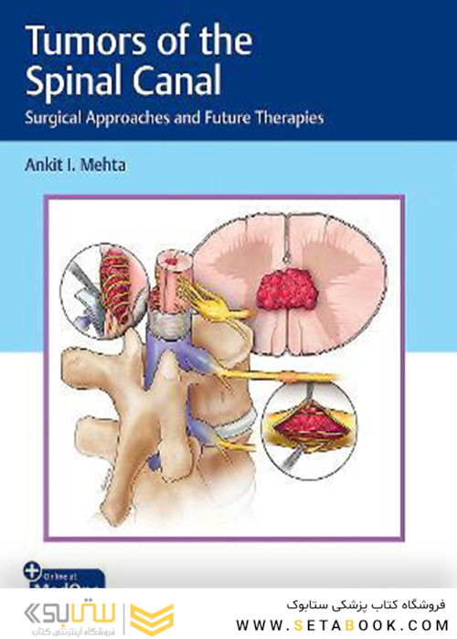 Tumors of the Spinal Canal: Surgical Approaches and Future Therapies 1st Edición