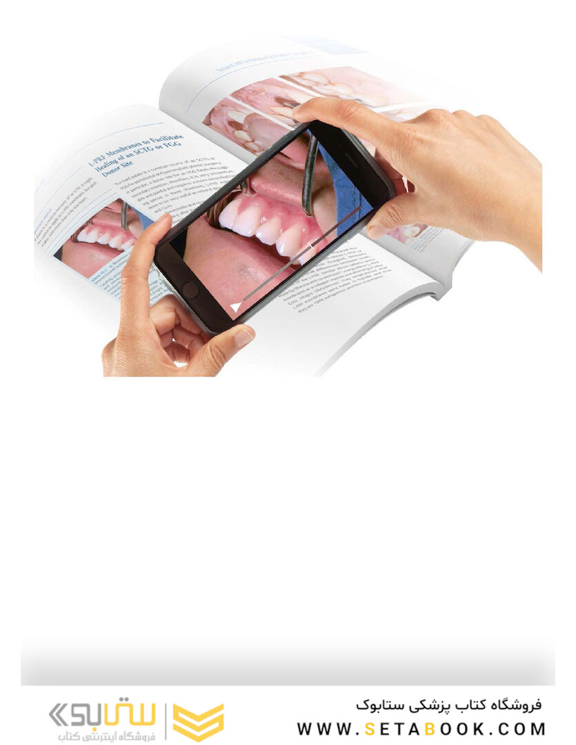 Leukocyte- and Platelet-Rich Fibrin in Oral Regenerative Procedures: Evidence-Based Clinical Guidelines 2022