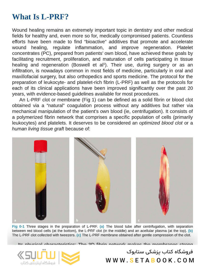 Leukocyte- and Platelet-Rich Fibrin in Oral Regenerative Procedures: Evidence-Based Clinical Guidelines 2022