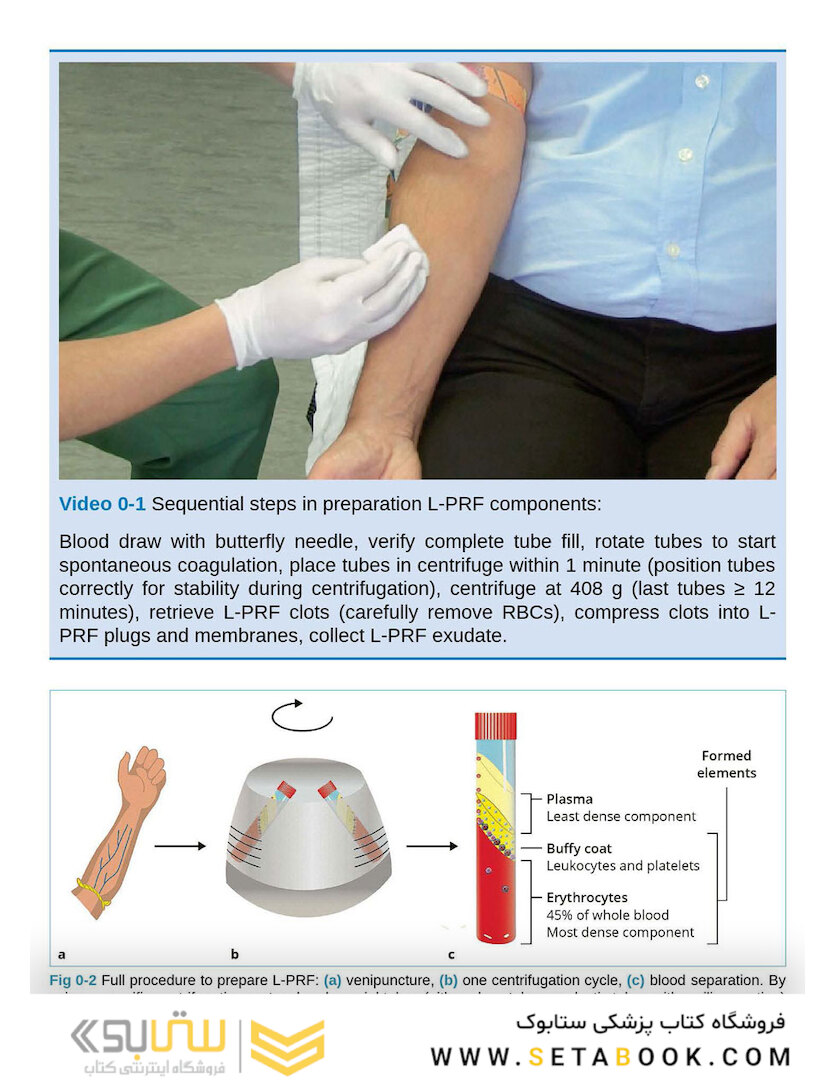 Leukocyte- and Platelet-Rich Fibrin in Oral Regenerative Procedures: Evidence-Based Clinical Guidelines 2022