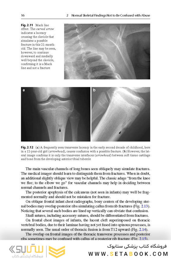 Recognizing Child Abuse in Radiology 1st ed. 2017 Edicion
