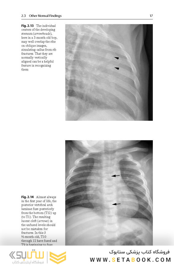 Recognizing Child Abuse in Radiology 1st ed. 2017 Edicion