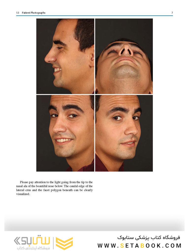 Aesthetic Septorhinoplasty 2021