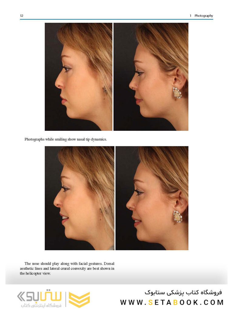 Aesthetic Septorhinoplasty 2021