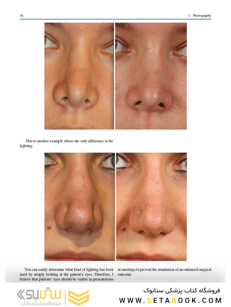 Aesthetic Septorhinoplasty 2021