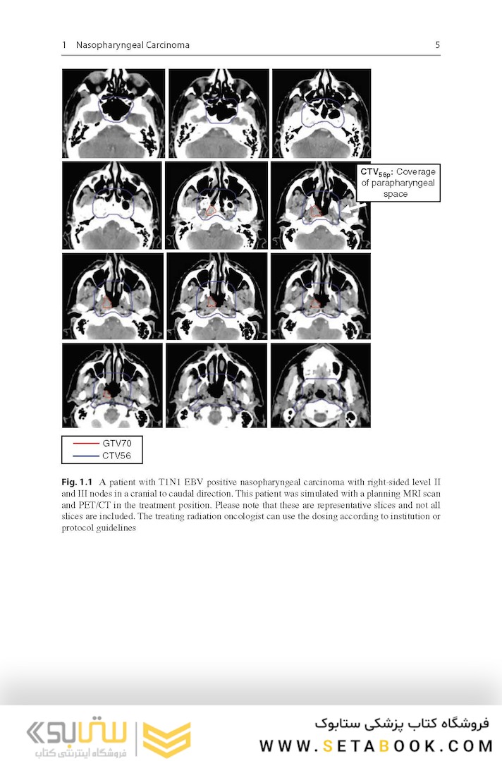 Target Volume Delineation and Field Setup : A Practical Guide for Conformal and Intensity-Modulated Radiation Therapy