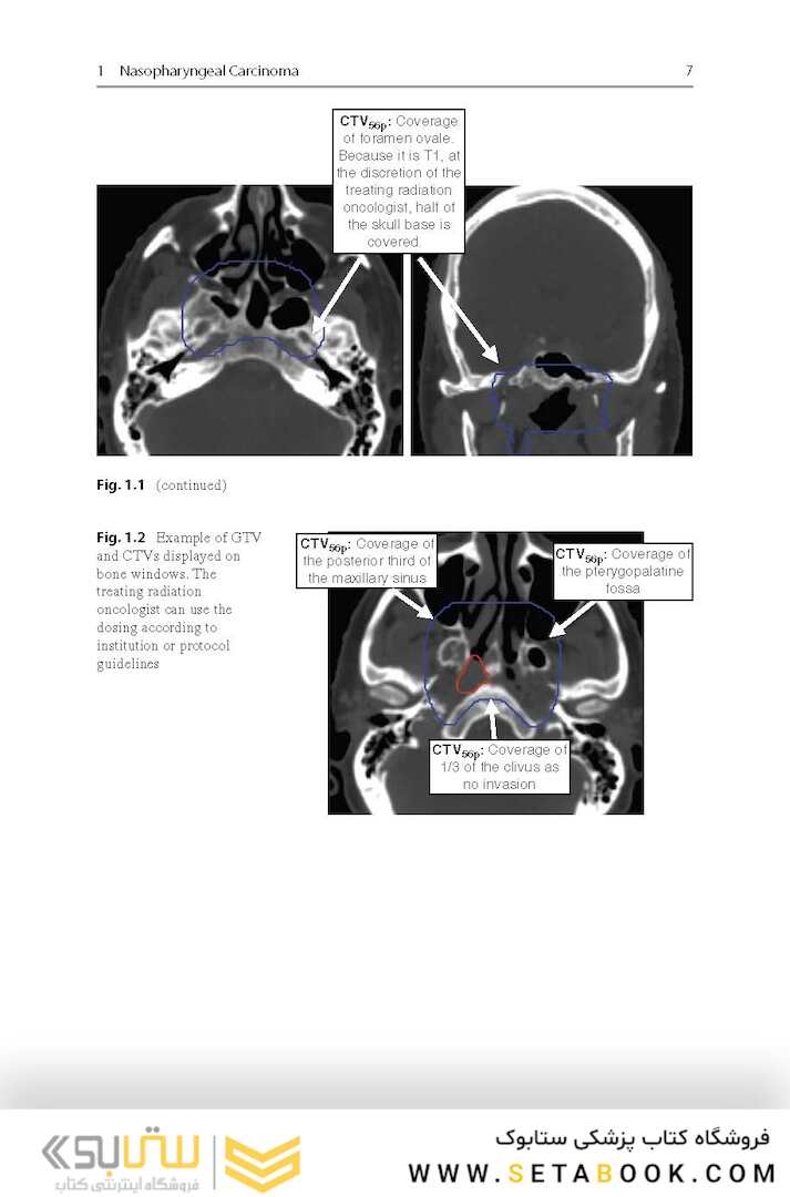 Target Volume Delineation and Field Setup : A Practical Guide for Conformal and Intensity-Modulated Radiation Therapy