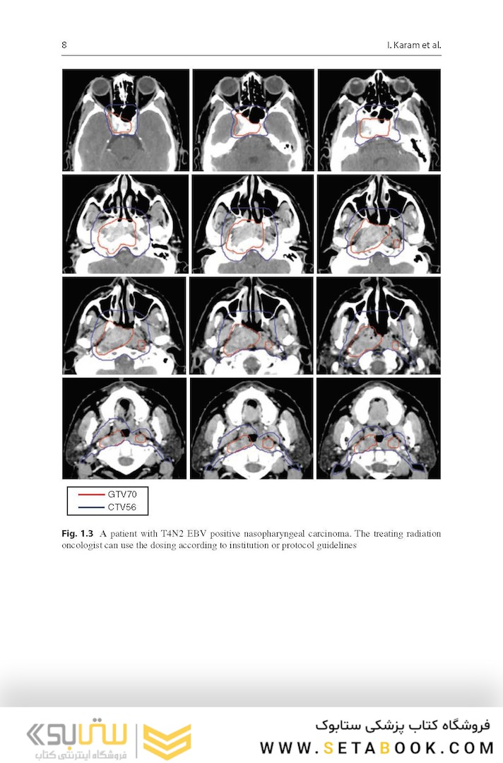 Target Volume Delineation and Field Setup : A Practical Guide for Conformal and Intensity-Modulated Radiation Therapy
