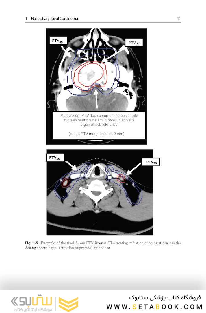 Target Volume Delineation and Field Setup : A Practical Guide for Conformal and Intensity-Modulated Radiation Therapy
