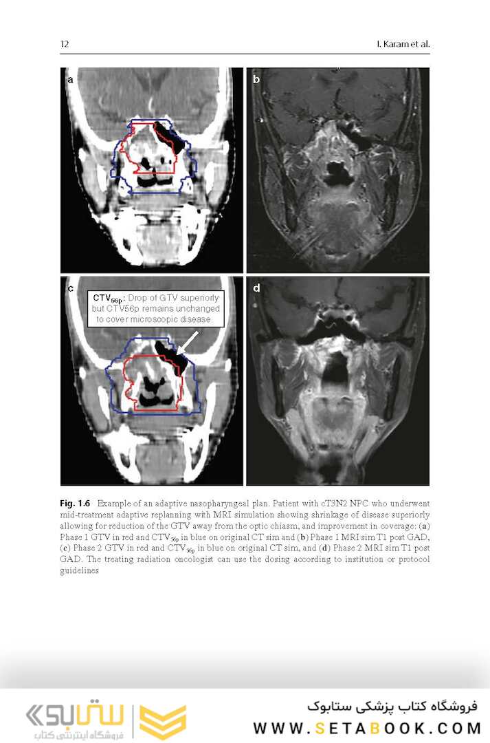 Target Volume Delineation and Field Setup : A Practical Guide for Conformal and Intensity-Modulated Radiation Therapy