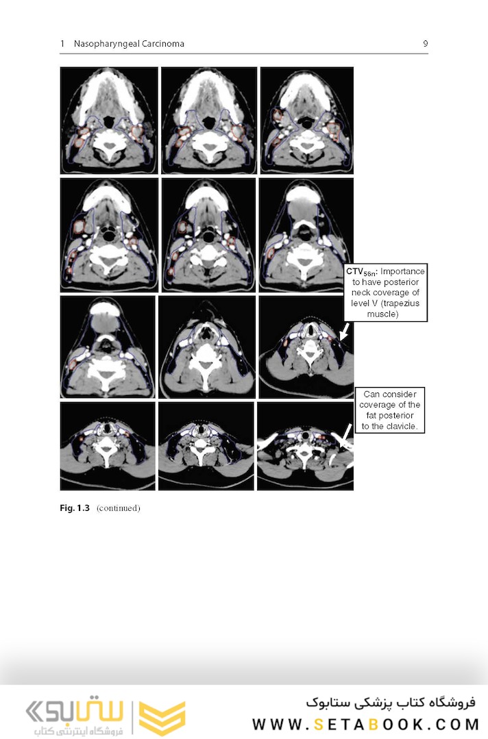 Target Volume Delineation and Field Setup : A Practical Guide for Conformal and Intensity-Modulated Radiation Therapy