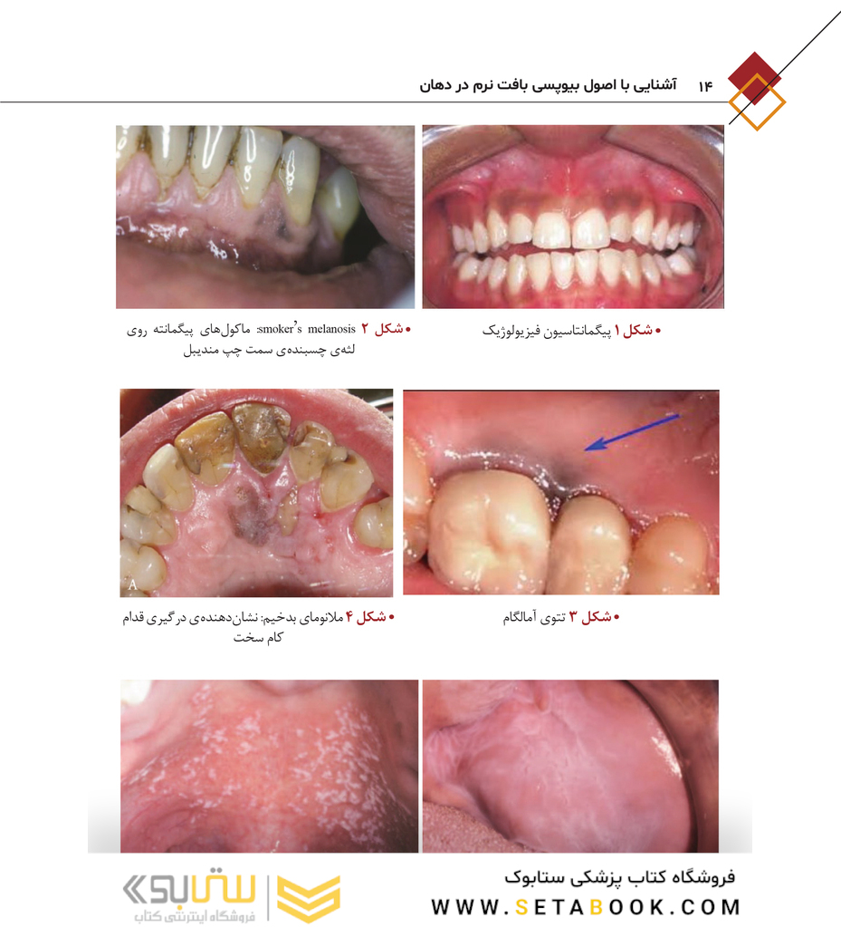 آشنایی با اصول بیوپسی بافت نرم در دهان