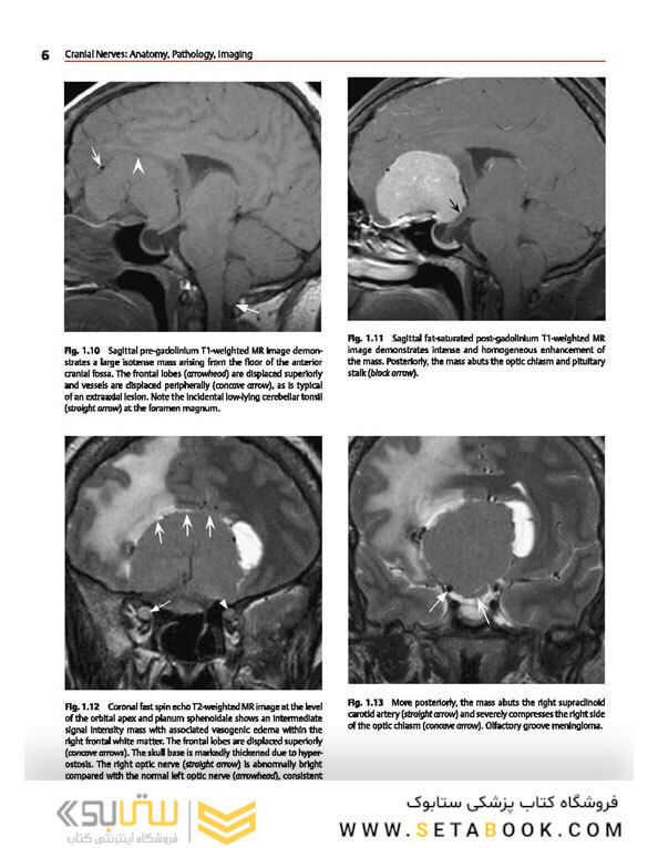 Cranial Nerves: Anatomy, Pathology, Imaging