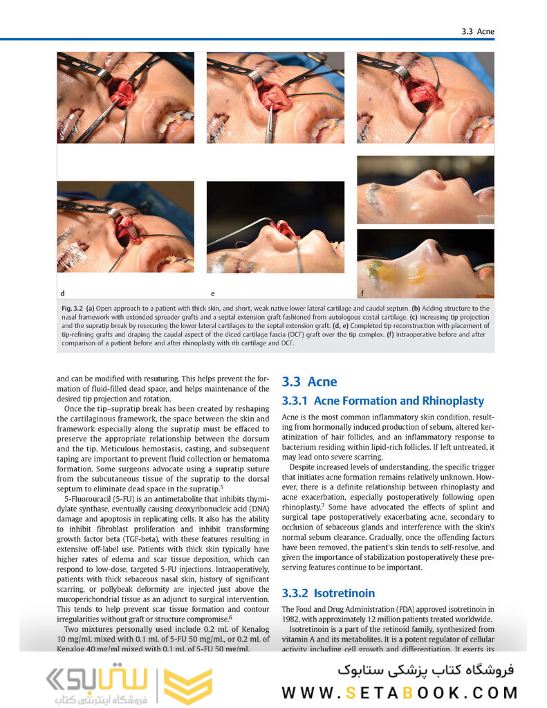 Global Rhinoplasty: A Multicultural Approach 1st Edicion 2023