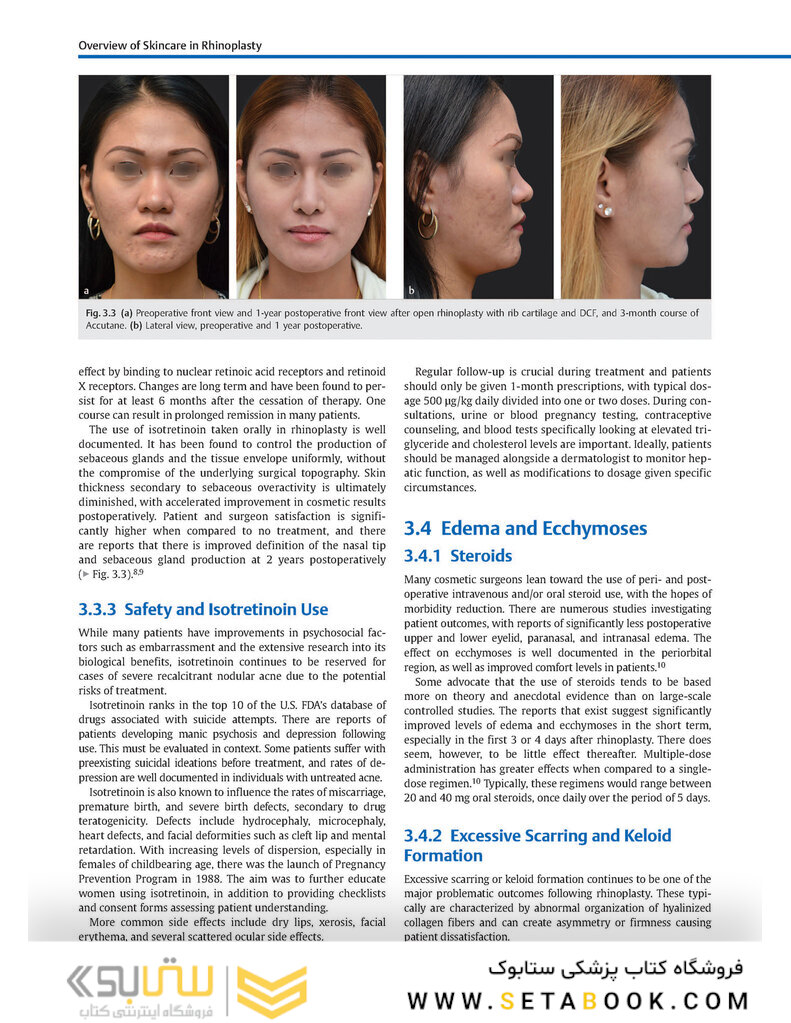 Global Rhinoplasty: A Multicultural Approach 1st Edicion 2023