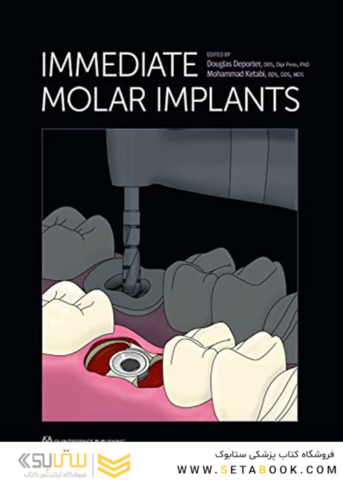 Immediate Molar Implants Kindle Edition