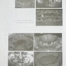 درمان بیماران بدون دندان (پروتز کامل 1)