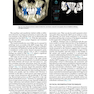 Principles and Biomechanics of Aligner Treatment