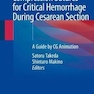 Compression Sutures for Critical Hemorrhage During Cesarean Section