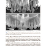 Clinical Management of Orthodontic Root Resorption