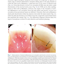 Clinical Management of Orthodontic Root Resorption