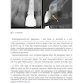 Clinical Management of Orthodontic Root Resorption