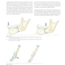 Principles of Internal Fixation of the Craniomaxillofacial Skeleton : Trauma and Orthognathic Surgery 2012