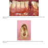 Rbfdps : Resin-Bonded Fixed Dental Prostheses: Minimally Invasive - Esthetic - Reliable