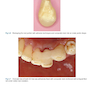 Rbfdps : Resin-Bonded Fixed Dental Prostheses: Minimally Invasive - Esthetic - Reliable