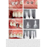 30Years of Guided Bone Regeneration in Implant Dentistry