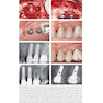 30Years of Guided Bone Regeneration in Implant Dentistry