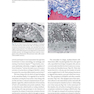 30Years of Guided Bone Regeneration in Implant Dentistry