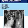 Neuromuscular Spine Deformity 1st Edition2018 تغییر شکل عضله عصبی عضلانی