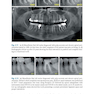 Shaping for Cleaning the Root Canals : A Clinical-Based Strategy 2022