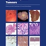 WHO Classification of Tumours. Digestive System Tumours : WHO Classification of Tumours